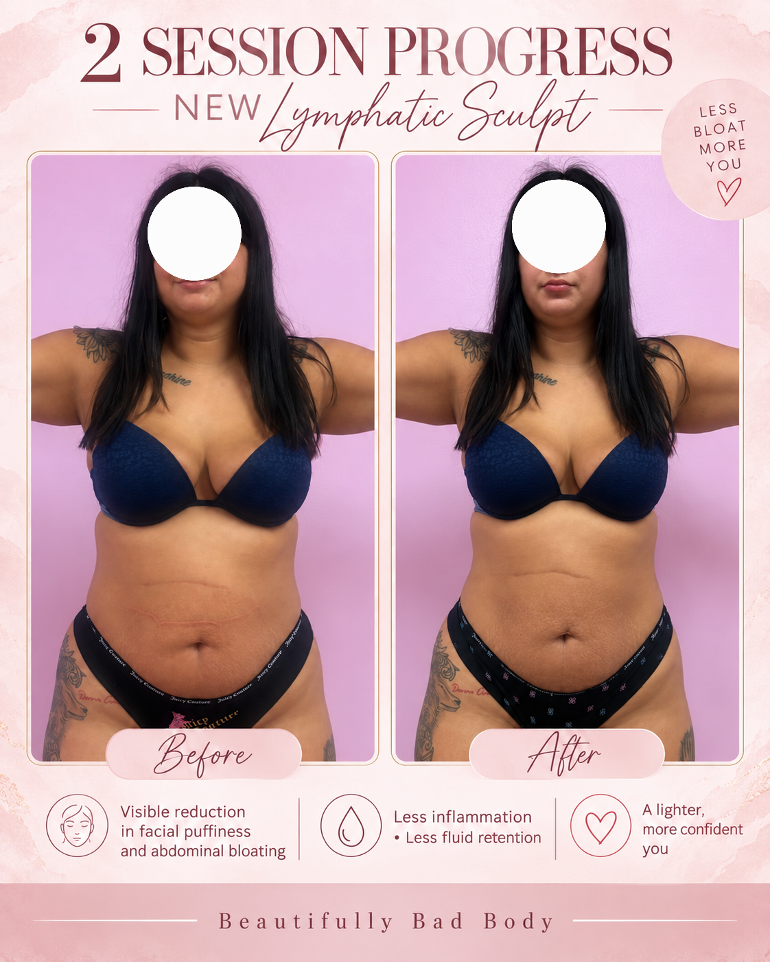 Lymphatic Sculpt progress after two sessions